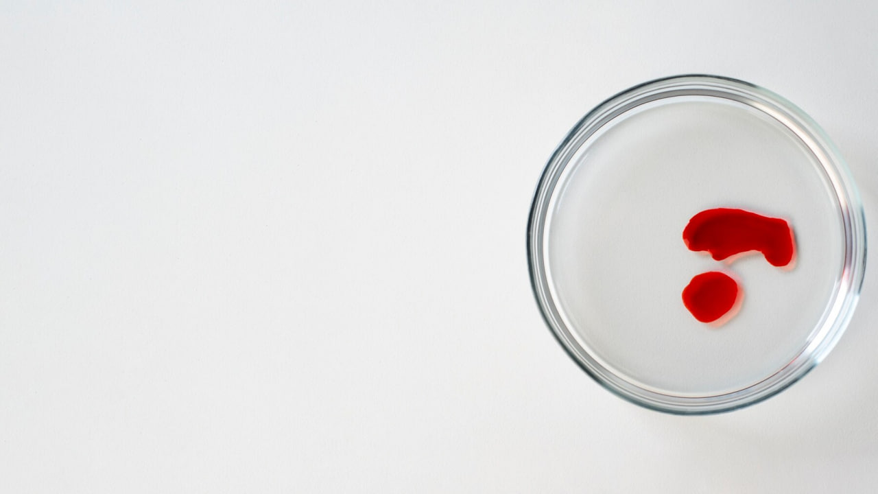 Низкая плотность гемоглобина